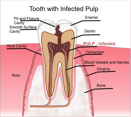 Tooth with infected Pulp and Cavity